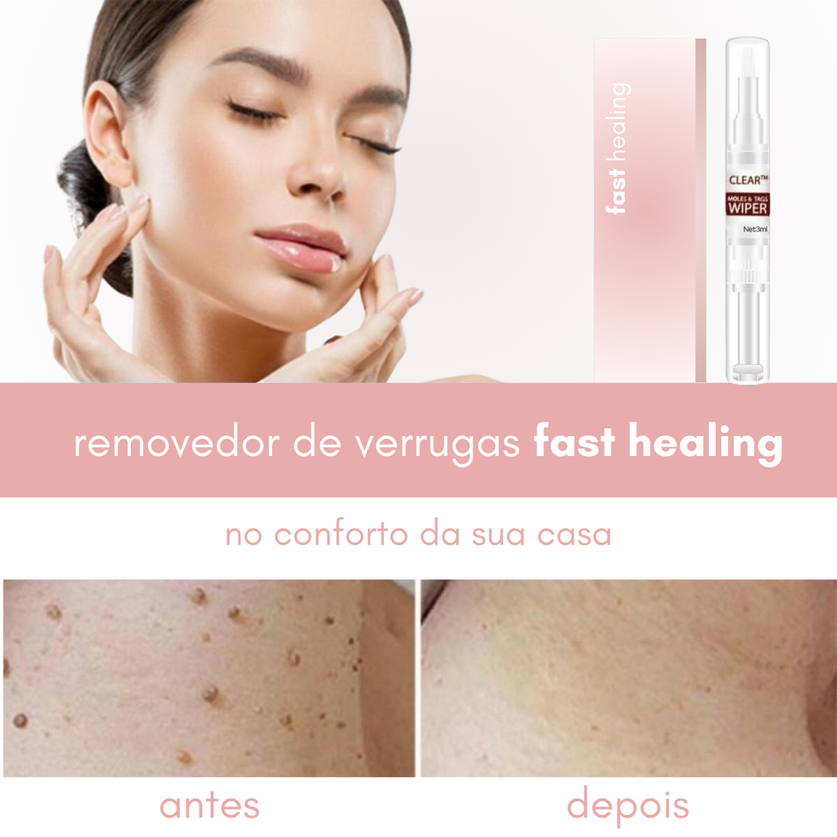 Creme Removedor de Verrugas – Fast Healing